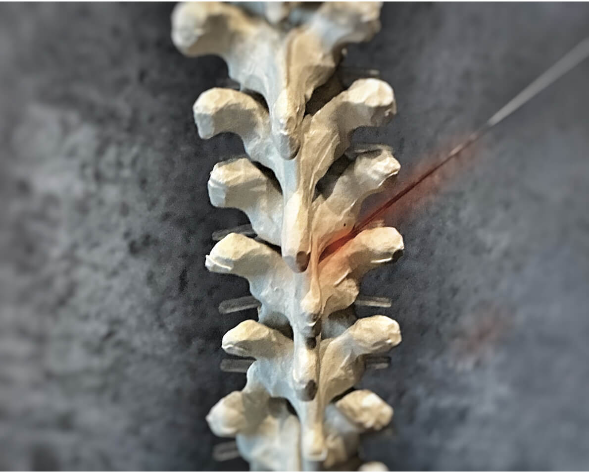 Thorakale Spinalnervenanalgesie (TSPA)