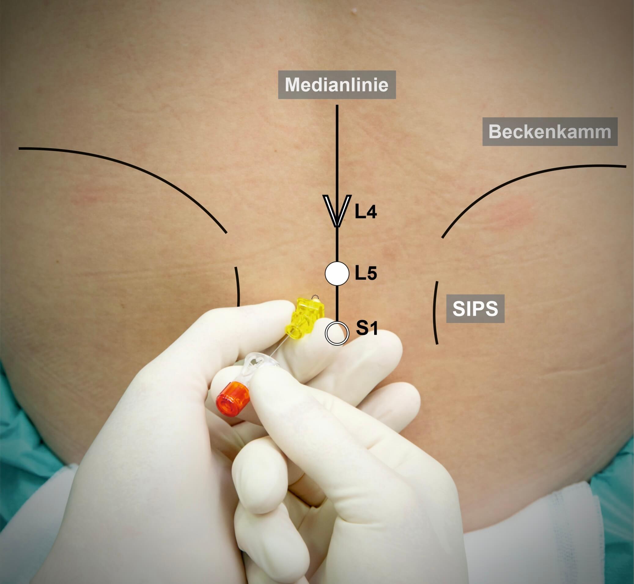 Epidurale Perineurale Injektion (Epi-peri)