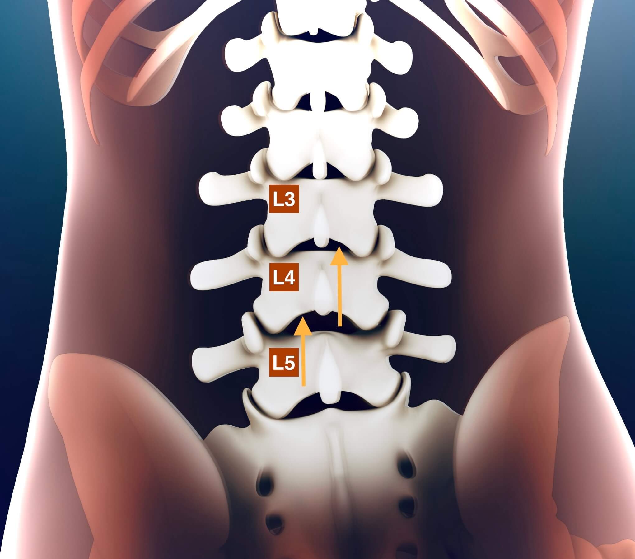 Epidurale dorsale interlaminäre Injektion (Epi dorsal)